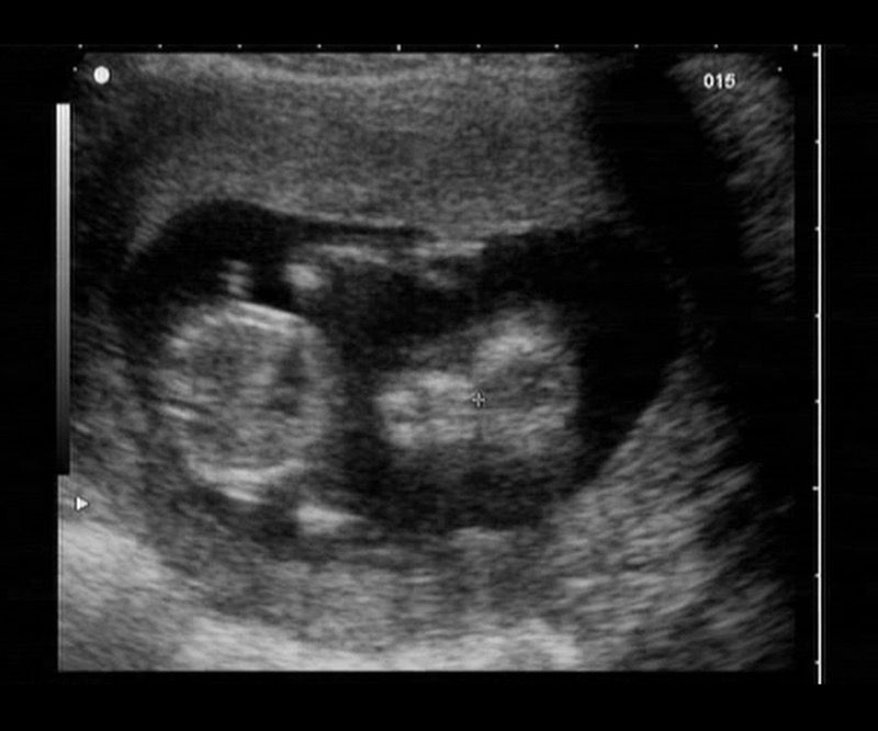 12_weeks_ultrasound